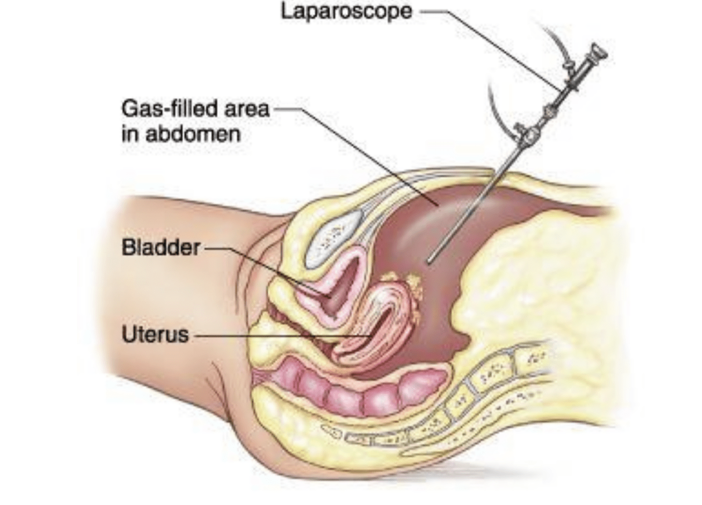 laporoscopy