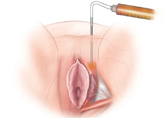 Labia Fillers