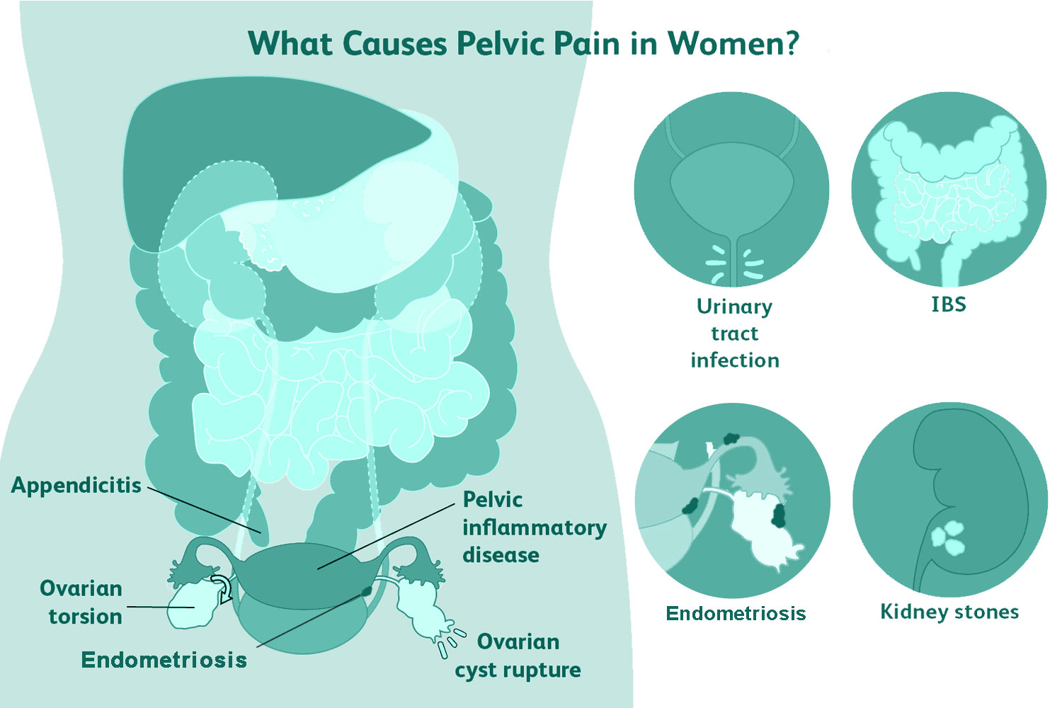 pelvic-pain pelvic pain